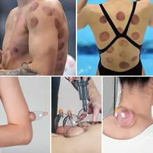 Portable Upgrade 20 Pcs Massage Therapy With Case, Pump Suction Cups For Cellulite Muscle Pain Relief Physical Therapy. - 20cups - View 6