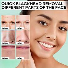 黑头去除面膜 - 鼻部及面部撕拉式黑头清洁套装 - 多色 - 查看 2