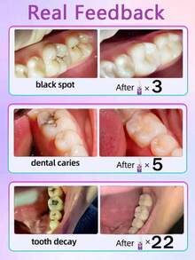 Teeth Cleaning Toothpaste Removes Tooth Stains Teeth Whitening Tooth Decay Repair Calculus Plaque Periodontitis Remove Cavities - 1件 - 查看 4