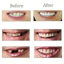 2pcs/Set Nuevas Dentaduras Postizas Superiores e Inferiores Sin Agujeros Mejoradas, Dientes Falsos Realistas, Decoración de Dientes para una Sonrisa Perfecta - Pegatinas dentales en caja - Ver 3