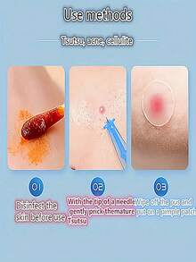 10/50/100/200pcs Professional Blackhead Removal Tool Set, Acne Needle, Facial Blemish And Acne Extraction Tool, Pimple Picking Needle - Professional Acne Removal Set, Suitable For All Skin Types, Facial Skin Pore Cleaning Tool Set, Facial Care Tool - Baby Blue - View 4