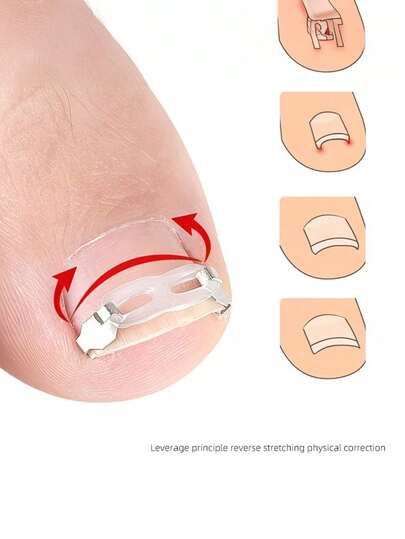 12件套嵌甲矫正套装，包含指甲矫正器、指甲支架、指甲矫正夹、嵌甲拔除器、指甲矫正贴纸、可重复使用的足部护理工具