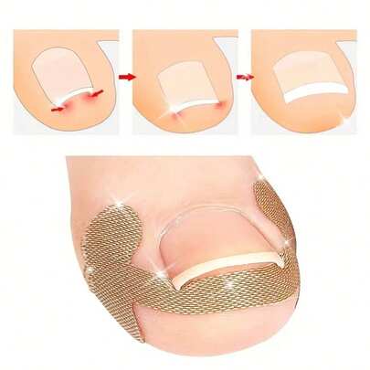 80 قطعة من أداة تصحيح أظافر القدم المتنامية، وسادات فاصلة للأصابع، مناسبة للاستخدام اليومي للرجال والنساء، تحسين أظافر القدم المتنامية بدون ألم