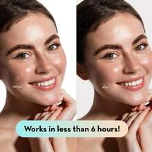 200pcs Scar Cover Patches, Conceal Scars, Invisible Body Blemish, Acne Stickers (Non-Cosmetic) - View 4