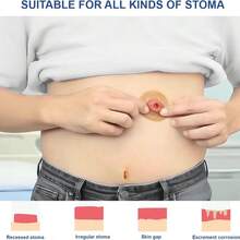 40Pcs 4mm Moldable Ostomy Rings, Hydrocolloid Stoma Barrier Rings for Colostomy Bags, Sting-Free - Ver 9