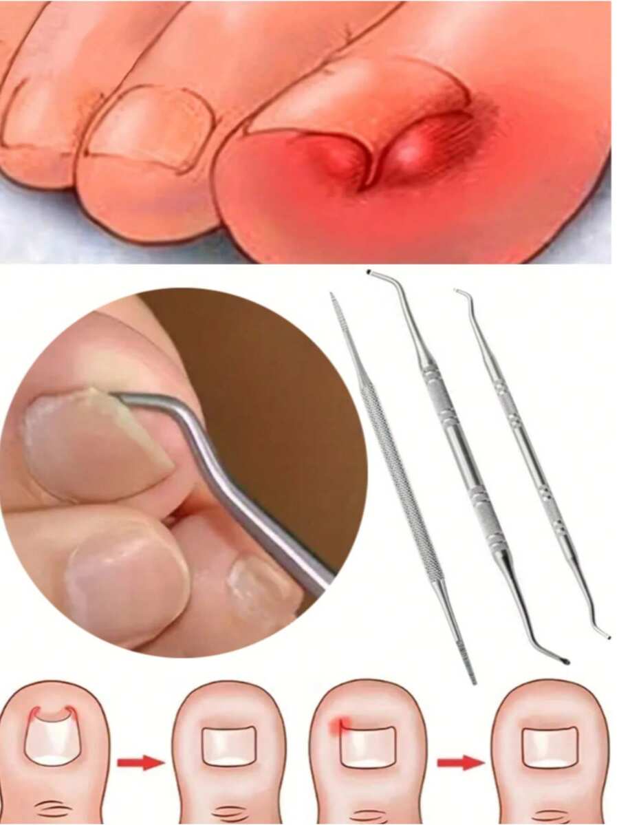 Bộ dụng cụ xử lý móng chân mọc ngược bằng thép không gỉ (1/3 món) - gồm dũa móng hai mặt, dụng cụ nâng, xẻng và đẩy móng; dùng để làm sạch, loại bỏ móng chân mọc ngược và làm sạch chất bẩn trên móng chân. - A - Xem 1
