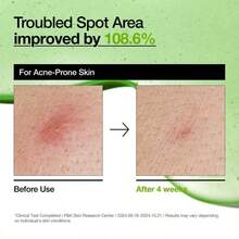 Azelaic Acid 10 Hyaluron Redness Soothing Serum, Facial Serum For Troubled & Sensitive Skin, Breakouts, Hyaluronic Acid, Niacinamide, Spot Care, Natural Color, Korean Skincare (30ml/ 1.01 Fl Oz.) - 數量 - 查看 6