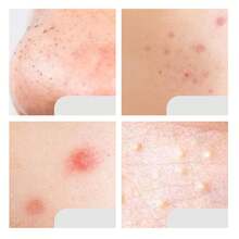 2-In-1 Stainless Steel Blackhead Remover Tool, Thickened Handle, Acne Cleansing Tool With Widened Pressing Ring, Non-Irritating, Comes With Storage Box, Unisex Skincare Essential - Multicolor - View 3