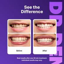 Teeth Whitening Strips-21 Applications For 30min Yellow Teeth Stain -Nano-Hydroxyapatite - Purple - View 5