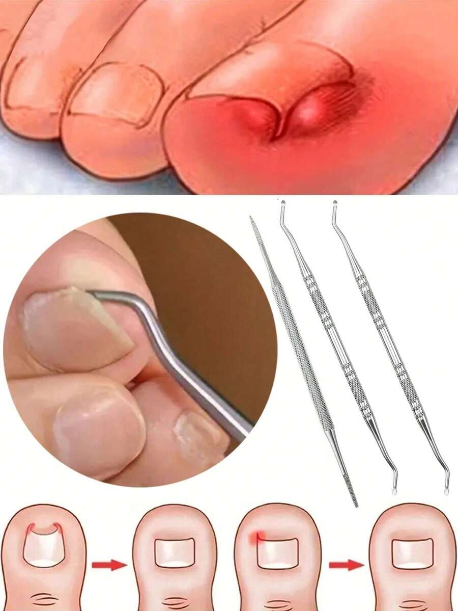 4/3/1 Set Kit d'outils en acier inoxydable pour les ongles incarnés - Lime à double face, releveur d'ongles, cuillère et repoussoir à ongles, pour nettoyer et retirer les ongles incarnés, avec sac de rangement et boîte de rangement - Argent - Voir 1