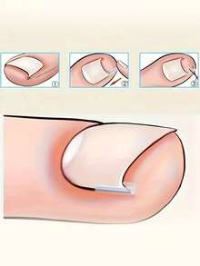 Bộ dụng cụ chăm sóc chân, gồm 10/20/30/40/50/60/70/80/90/100 món, dùng để điều trị móng chân mọc ngược. - Nhiều màu - Xem 5