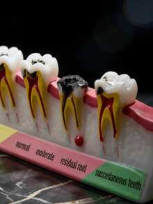 Modelo de patología de caries dental, demostración de salud oral, accesorio de exhibición de etapas de enfermedades dentales, adorno para regalo de dentista, higienista dental, educación en escuela dental - Multicolor - Ver 2