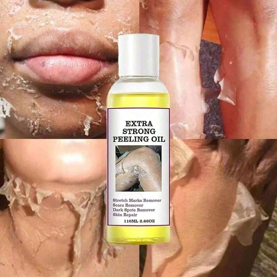 Yellow Peeling Oil For Dark Skin Strong Peel Oil Extra Strength Exfoliating Chemical Exfoliant Peels Solution At Home Body Peeling For Exfoliate Body Hand Foot Knuckle All Skin Type - Default - View 1