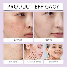 Azelaic Acid Acne Care Cream Mild Moisturizing Improve Facial Acne Brightening And Moisturizing Moisturizing Face Cream - Vitamin C - Xem 7