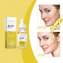 Acne Removing And Skin Clearing Essence Can Improve Oily Acne Muscle, Control Oil, Refine Pores, Reduce Defects, Relieve Redness, Fade Acne Mark Sensitive Muscle, Available 30ml - axit salicylic - Xem 1