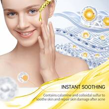 Acne Removing And Skin Clearing Essence Can Improve Oily Acne Muscle, Control Oil, Refine Pores, Reduce Defects, Relieve Redness, Fade Acne Mark Sensitive Muscle, Available 30ml - axit salicylic - Xem 10