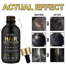 5% Minoxidil For Men And Women Hair Growth, Biotin Hair Growth Serum Hair Regrowth Treatment For Scalp Hair Loss Hair Thinning, Natural Hair Growth For Thicker Longer Fuller Healthier Hair 2.02 Oz - 1 - 查看 3