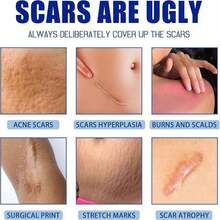 Silicone Scar Gel, Scar Cream For Surgical Scars, Stretch Marks & Keloid Bumps, Effective Scar Removal Cream (1 Pc) - A - 查看 6
