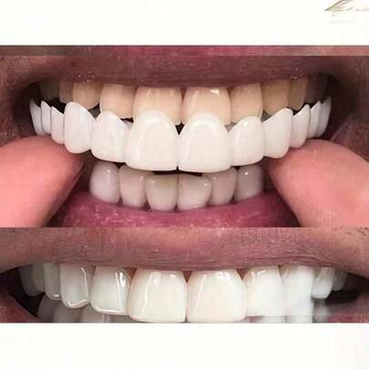 1 Set de Carillas Dentales Suaves y Cómodas de Color Blanco, Cubiertas Falsas para Sonreír, Incluye Filas Superior e Inferior, Solución Unisex Fácil de Usar para Ocultar Defectos Dentales, Aumenta la Confianza, Carillas Cosméticas Temporales, Reparación Universal de Defectos Dentales