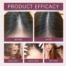 Aceite para el Crecimiento del Cabello Hoegoa con Jengibre y Romero, Nutrición Profunda, Mejora la Sequedad, Retención de Longitud, Reparación Intensiva, Aceite Esencial para el Cabello - 1 - Ver 7