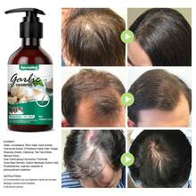 Champú de ajo, champú anticaspa para el cabello con picazón, elimina la caspa, hongos, previene la picazón del cuero cabelludo, la psoriasis y la caída del cabello - 1 - Ver 6