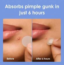 Pimple Patches For Face (1250 Count), Cut-To-Size Hydrocolloid Roll Tape - Pimple Patch Pimple Stickers - Absorb Gunk &Amp; Fast Healing - Acne Pimple Patches For Face - Zit Patches - For All Size Acne - 白色 - 查看 5