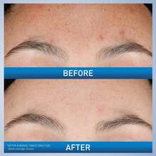 CeraVe Resurfacing Retinol Serum For Post Acne Marks, Formulated With Licorice Root Extract & Niacinamide, Brightening Serum & Pore Minimizer For Face, Post Acne Skin Barrier Repair, Non-Comedogenic - Retinol - 查看 2