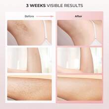 Laser Hair Removal Devices - 1 - View 7