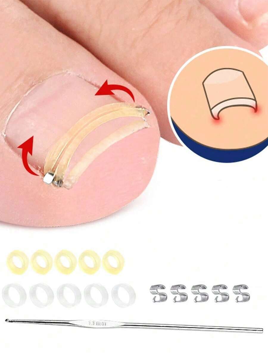 1pc Ingrown Toenail Correction Tool Set, Physical Reverse Stretching Painless Improvement For Ingrown Nails, Relieves Paronychia Pain, Suitable For Men And Women Daily Foot Care, Elegant Gift - Multicolor - View 1