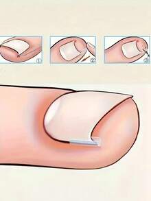 100pcs/Set Ingrown Toenail Correction Pads, Painless Ingrown For All Types Of Foot Care - Multicolor - View 2