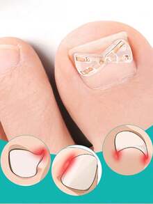 1/2 cái dụng cụ chỉnh móng chân mọc ngược không đau, phù hợp cho mọi loại chăm sóc bàn chân - Nhiều màu - Xem 3