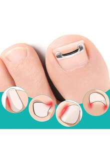 1/2pcs Painless Ingrown Toenail Corrector, Suitable For All Types Of Foot Care - Multicolor - View 5