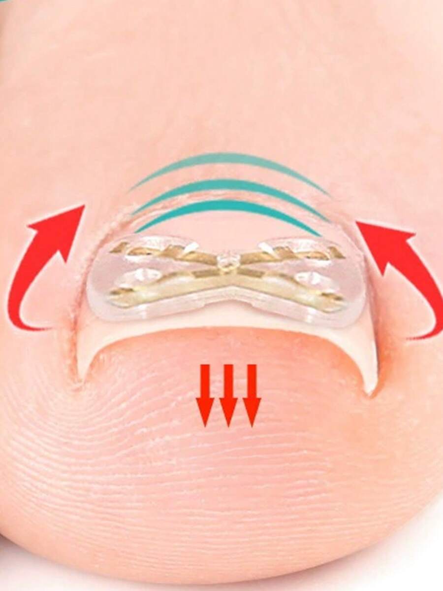 1/2 cái dụng cụ chỉnh móng chân mọc ngược không đau, phù hợp cho mọi loại chăm sóc bàn chân - Nhiều màu - Xem 1