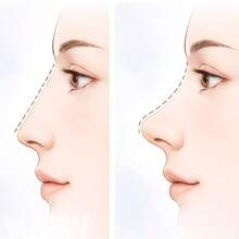 2 PIEZAS/Entrenador de Elevación del Puente Nasal para Dormir - Entrenador Facial del Puente Nasal - Herramienta de Entrenamiento Nasal - Mejorar el Puente Nasal - Elástico; Adecuado para Varias Formas de Nariz - Unisex - Antideslizante - Uso Día y Noche - Relajado; Entrenador Facial para Principiantes - Regalo - Blanco - View 7