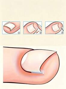 Embedded Long Toenail Strips - Transparent, Ingrown Toenail Correction Treatment Kit, Odorless Toenail Braces, Toenail Care Pad Set, Professional Toenail Insertion Foot Tools And Foot Tools - Multiple Styles - View 4