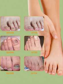 2/10/50/100pcs/Set Tea Tree Oil Nail Stickers, Invisible Wearable With Shoes, Thin & Breathable, Daily Care, Skin-Friendly Formula, Long-Lasting Adhesion, Focused On Foot Health, Perfect Assistant For Foot Care - Multicolor - View 5