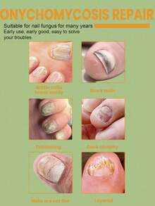 2/10/50/100pcs/Set Tea Tree Oil Nail Stickers, Invisible Wearable With Shoes, Thin & Breathable, Daily Care, Skin-Friendly Formula, Long-Lasting Adhesion, Focused On Foot Health, Perfect Assistant For Foot Care - Multicolor - View 6