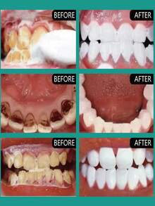 Polvo dental de limpieza suave, polvo de cuidado oral suave diario - Multicolor - Ver 3
