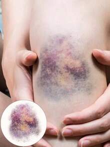 Large Realistic Bruise Temporary Tattoo Sticker, Waterproof Long-Lasting Fake Injury Tattoo, Big Purple Yellow Bruised Body Art For Leg Arm Knee, Funny Gag Gift For Prank, Halloween SFX Costume Party - Multicolor - View 4