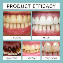 Teeth Whitening - 1 - View 5