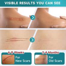 Silicone Scar Sheets, Silicone Scar Tape(5.7" X 1.57" 10 Pcs), Silicone Scar Sheets For Surgical Scars, Keloid Bump Removal, Stretch Marks Removal, C-Section, Burn Et - 10 PCS - View 7