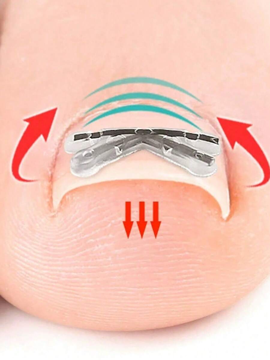 2pcs/Set Toe Braces, Flexible Nail Correction Strips, Suitable For Curved Toenails, Invisible Nail Lift Support Clips, Portable Foot Care Pedicure Tools, Suitable For Wearing Shoes, Walking And Daily Use - Multicolor - View 1
