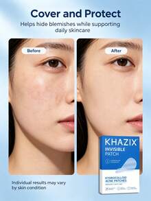 720pcs Invisible Acne Cover Patches - Comfortable, Breathable, Lightweight And Portable. Super Strong Adhesion Suitable For Covering And Caring - Round - View 4