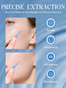 200/100PCS Acne Needle, Closed-End Needle, One-Time Use Fat Particle Removal Tool For Removing Pimples, Squeezing Acne, Clearing Acne, Acne Removal Needle, Dark Spot Removal Needle, Cleaning Tool - Baby Blue - View 3