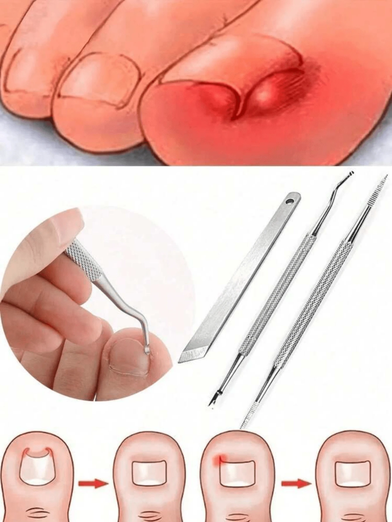 1/4 件不锈钢脚趾甲修剪刀脚刮刀脚指甲护理双面修脚指甲锉老茧去除器用于清洁和去除嵌甲、袋子、整理器、存储