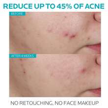 Rostro RadianteLa R-oche Posa Effaclar Serum Ultra Concentrado Anti-Marks 30ml - Peeling Diario Para Disminuir Marcas Y Mejorar La Textura, Regalo Exclusivo Para San Valentín 2025, Uso Continuo, Ideal Para Piel Mixta Y Sensible - Blanco - Ver 3