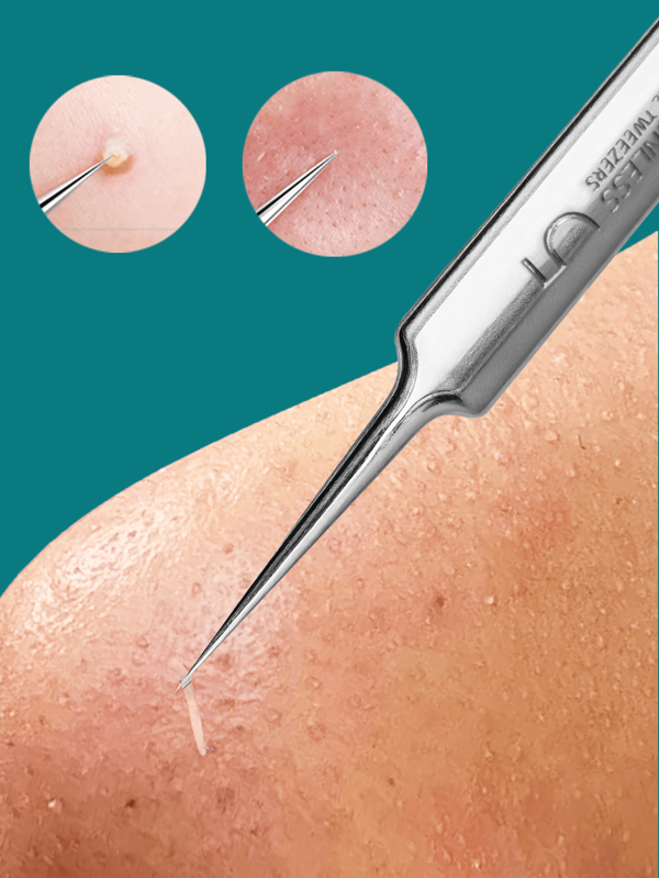 1 peça de ferramenta para remoção de cravos, pinça de ponta fina de aço inoxidável para acne, manchas, cravos, espinhas, ferramenta profissional de limpeza facial para rosto e nariz, tipo de pele normal - kit profissional de cuidados faciais para acne e cravos