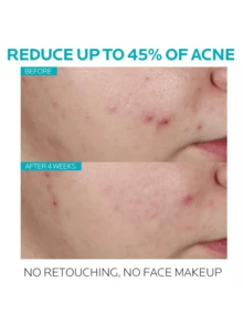 La Roche-Posay La R-oche Posa Effaclar Serum Ultra Concentrado Anti-Marks 30ml - Peeling Diario para Disminuir Marcas y Mejorar la Textura, Regalo Exclusivo para San Valentín 2025, Uso Continuo, Ideal para Piel Mixta y Sensible - Blanco - Ver 2