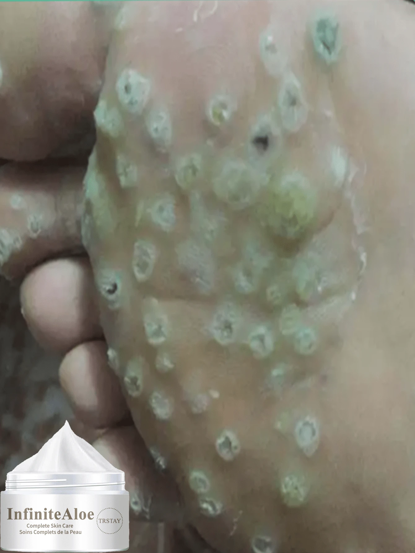 Improve The Accumulation Of Dead Skin On The Sole Of The Foot, Mildly Soften And Coarsely Relieve Itching And Peeling, Repair Foot Essence - Nhiều màu - Xem 1