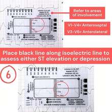 NetHong ECG/EKG 7 Step Ruler Card For ECG/EKG Interpretation Portable ECG EKG Card Ruler - Transparent - View 7